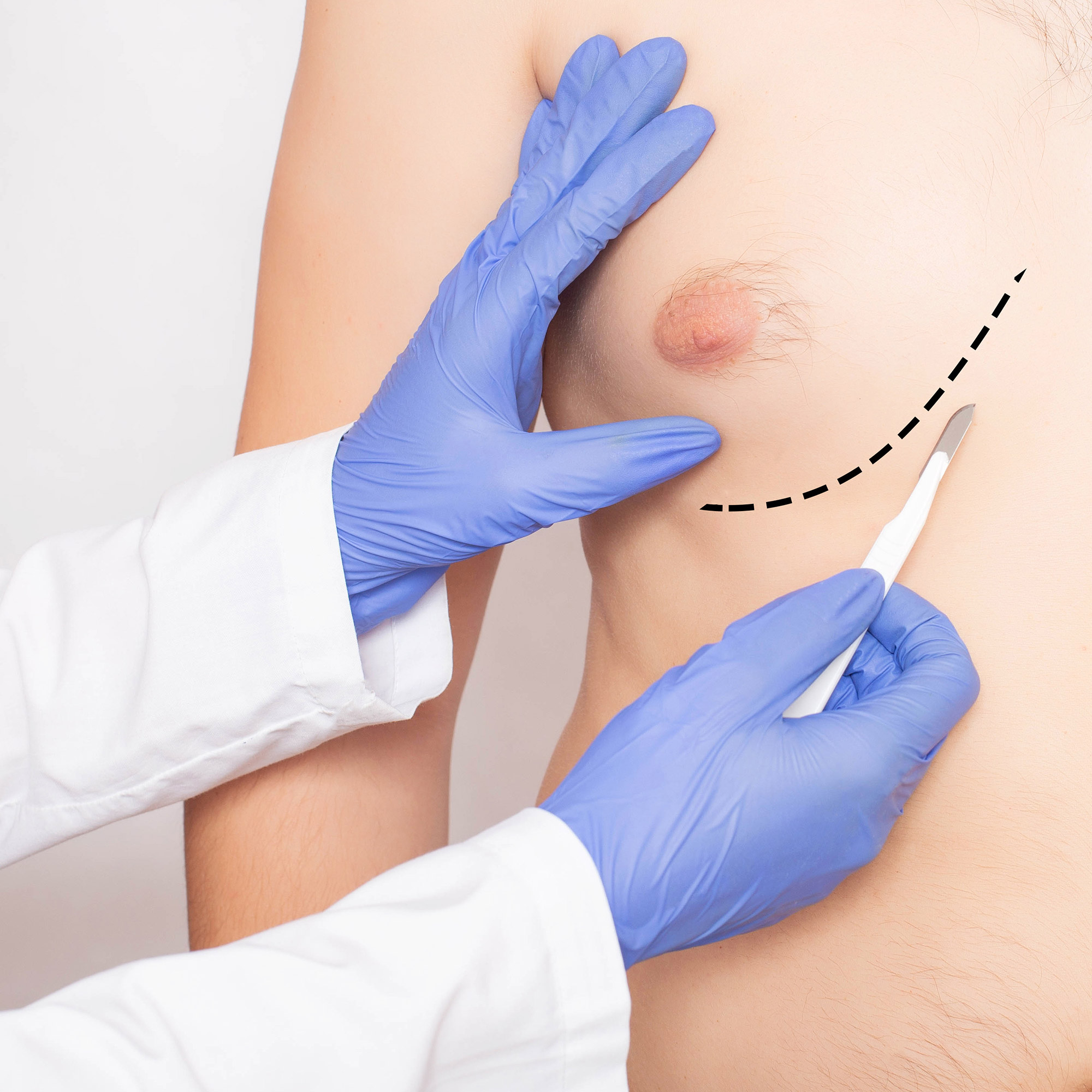 Gynecomastia | William Samson | New York City Male Breast Reduction
