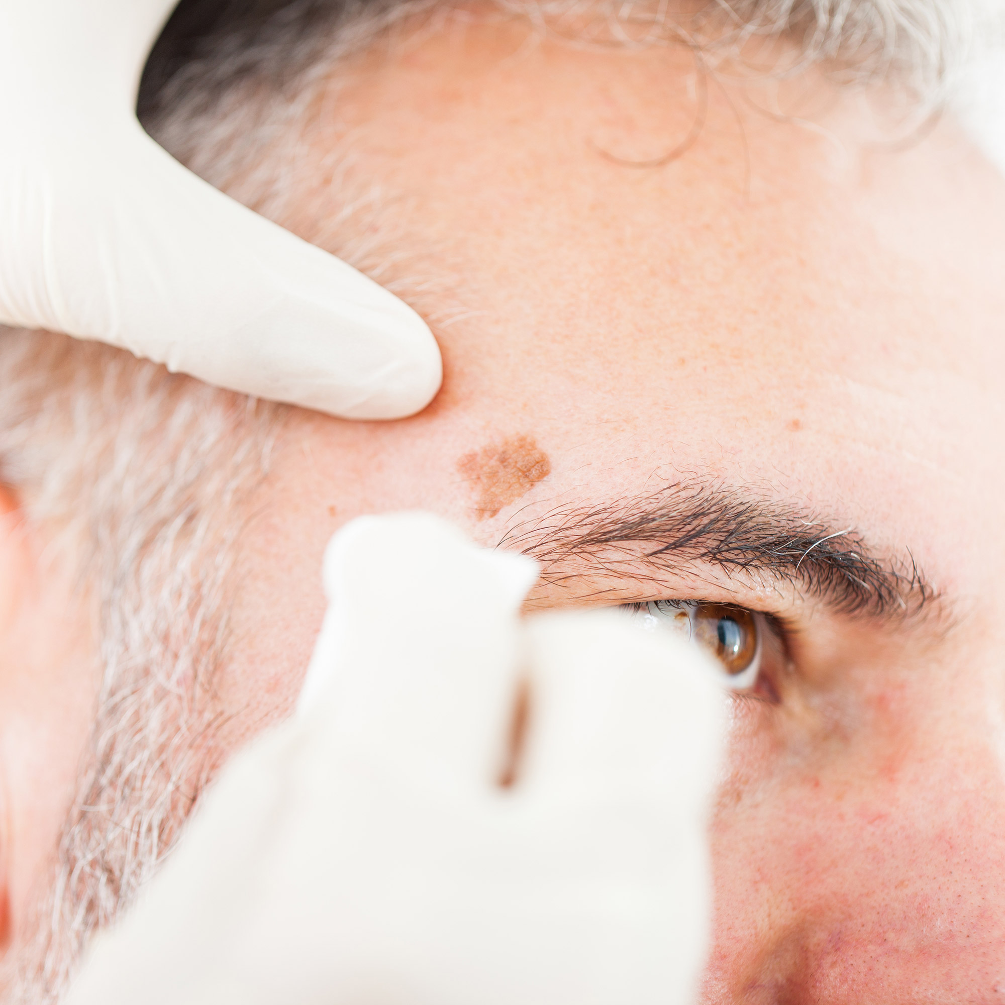 Getting Spot removerd | William Samson | New York City Skin Cancer Reconstruction