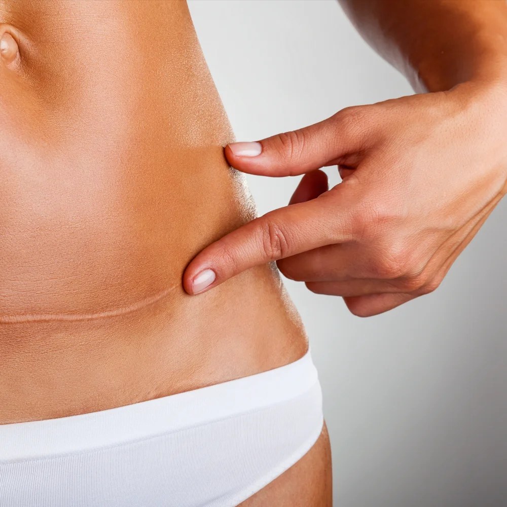 Woman pointing to scar on abdomen